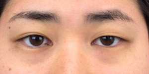 192 [Instant Double Eyelid Surgery]