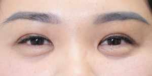 193 [Instant Double Eyelid Surgery]