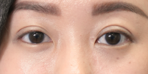 195 [Instant Double Eyelid Surgery]
