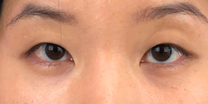 196 [Instant Double Eyelid Surgery]