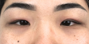 197 [Instant Double Eyelid Surgery]